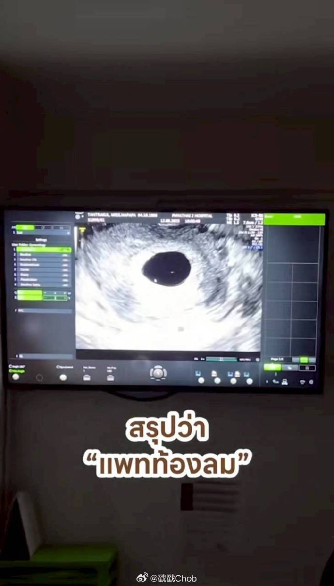 Pat Napapa分享怀孕喜讯反转 遗憾确诊“空孕囊”