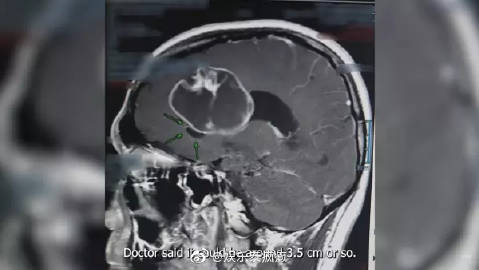 Pok Patsarakorn自曝确诊脑瘤紧急开颅手术 曾一度被告知仅剩两年生命