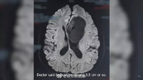 Pok Patsarakorn自曝确诊脑瘤紧急开颅手术 曾一度被告知仅剩两年生命