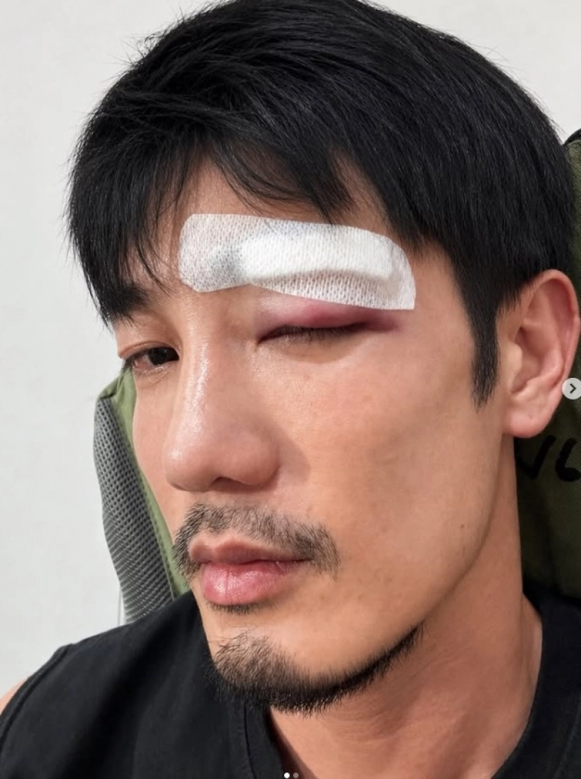 Auan Rangsit打篮球意外受伤 满脸鲜血缝26针吓坏粉丝